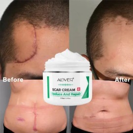Crema Apoyo Desvanecimiento Cicatrices Cacarizos Queloides