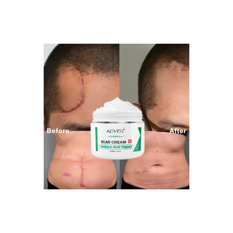 Crema Apoyo Desvanecimiento Cicatrices Cacarizos Queloides