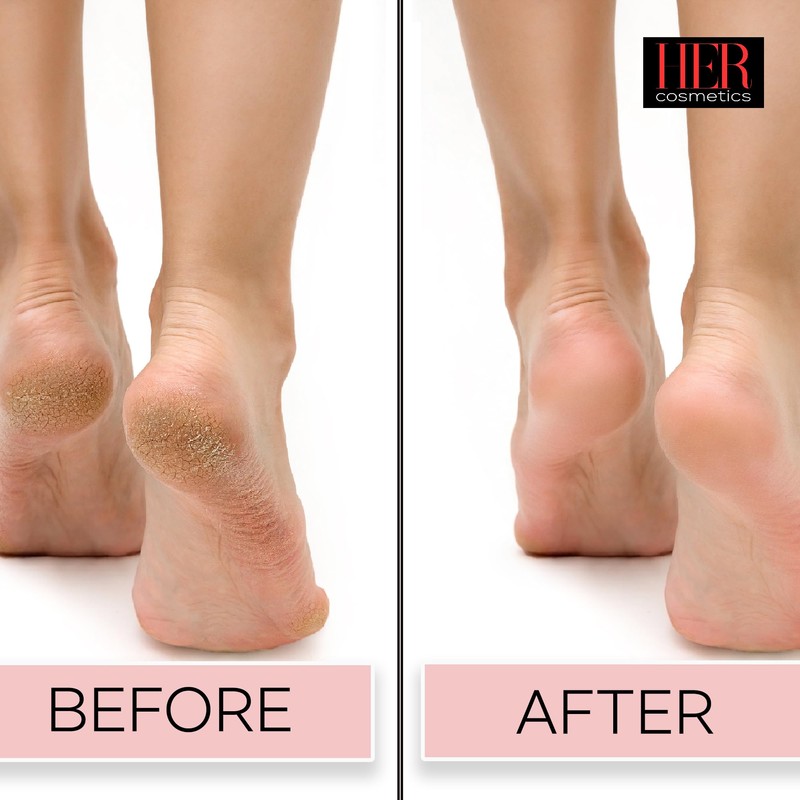 Extreme Callus Remover Gel for Feet and Foot Eliminates Calluses