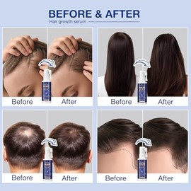 VENANOCI Spray de aceite para el crecimiento del cabello: suero natural para el crecimiento del cabello con romero, biotina, tratamiento contra la pér