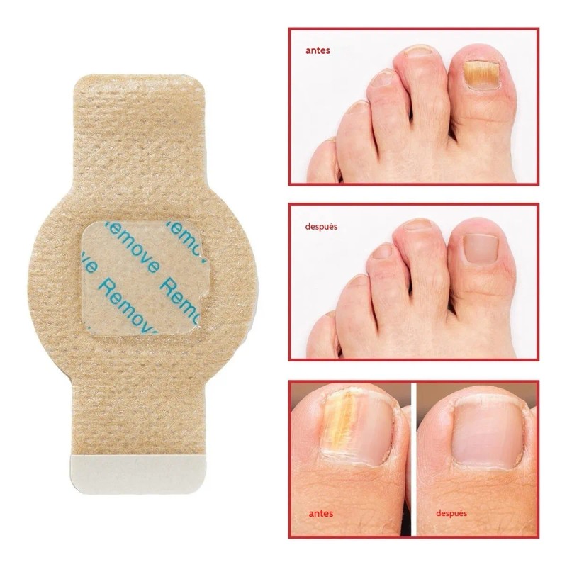 Parches De Uñas Fúngicas, 42pcs De Tratamiento