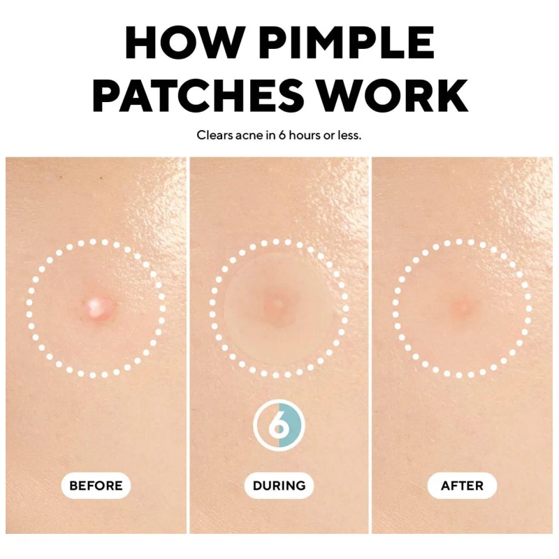 Caraseoul Parches Para Espinillas, Parche Hidrocoloide Para