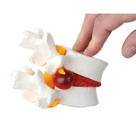 Axis Scientific Human Lumbar Herniating Disc Demonstration Anatomy Model for Teaching and Learning