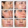 Dark Spot Remover for Face，-Age Spot Remover -Hyperpigmentation Treatment-Sun Spots