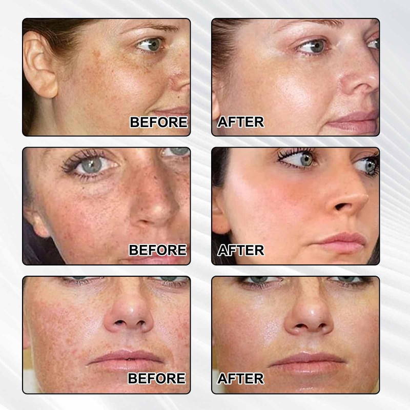 Dark Spot Remover for Face，-Age Spot Remover -Hyperpigmentation Treatment-Sun Spots
