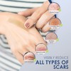 Admirada Silicone Sheets for Scars: Reusable Scar Care Tape for