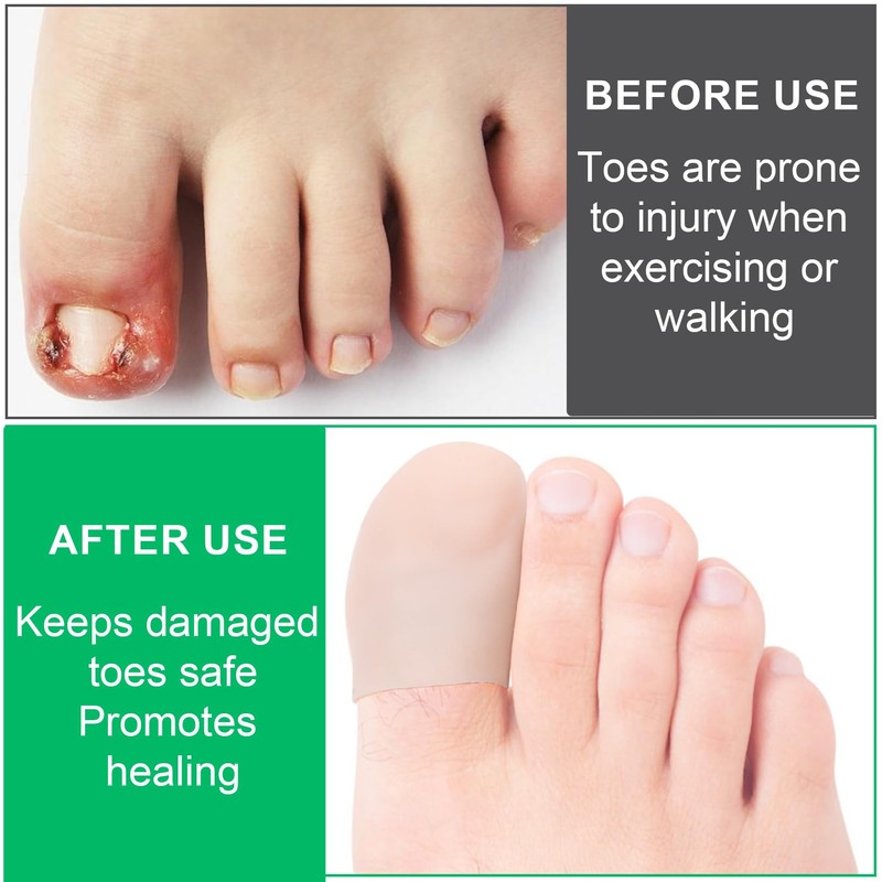 STSTR 10 PCS Soft Gel Toe Caps, Elastic Toe Protectors