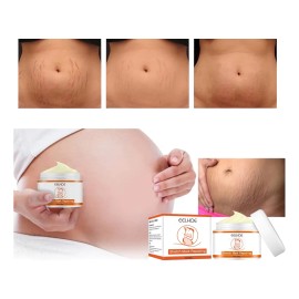 Tratamiento Profesional Permanente Eliminar Estrías Neutra