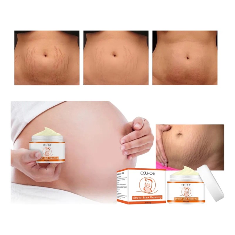 Tratamiento Profesional Permanente Eliminar Estrías Neutra
