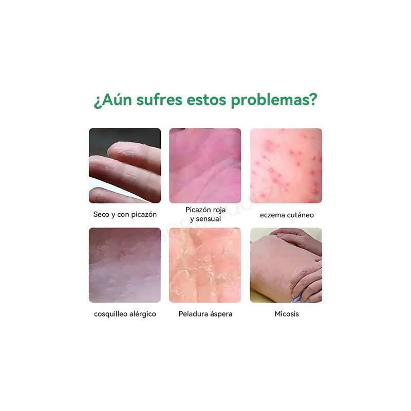 2p Crema De Psoriasis Para Varios Síntomas De Psoriasis 20g