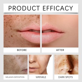 Freckle Removal Cream,Dark Spot Remover for Face and Body,Dark Spot Corrector Freckle Remover,Skin Brightening Cream,Moisturizing Anti-blemish Cre/am,Da/rk Spot Correcting Glow Serum,Spot Cre/am