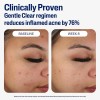 Cetaphil Crema Hidratante Facial Matificante Para Acné 89ml