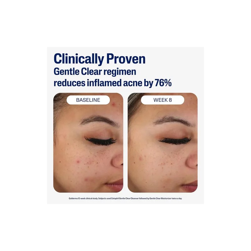 Cetaphil Crema Hidratante Facial Matificante Para Acné 89ml