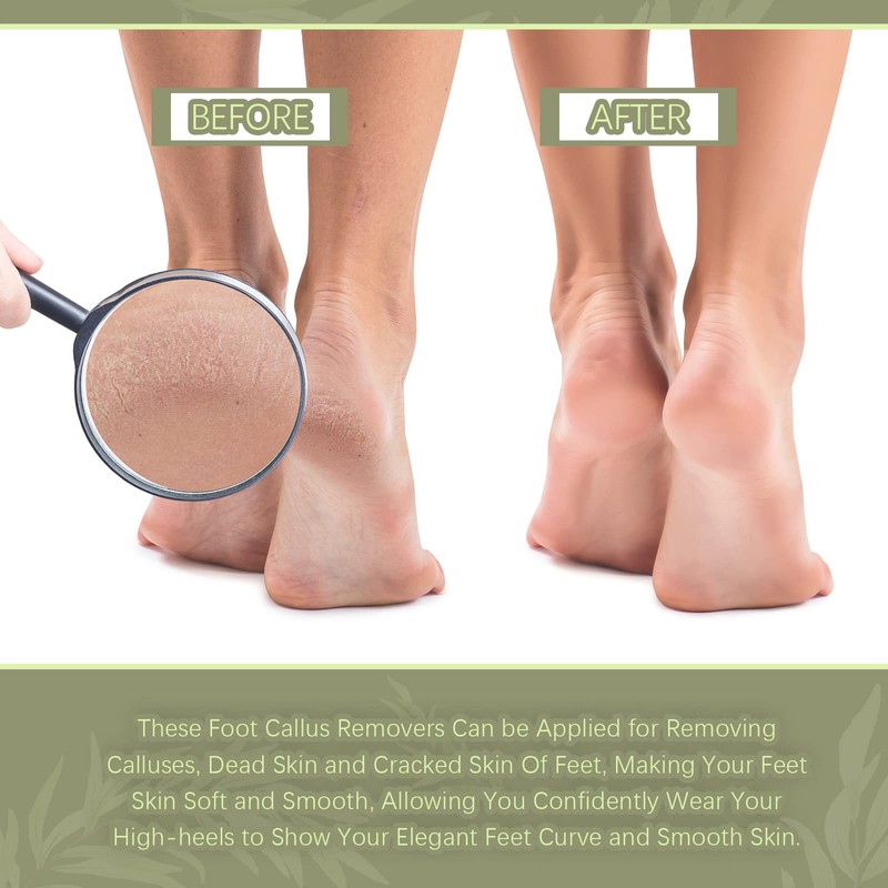 Foot File Double Sided Callus File Foot Care Callus Rasp