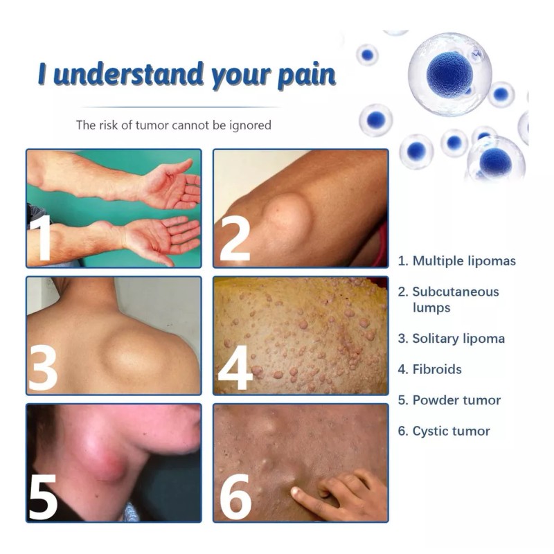 Generic 2× Crema De Eliminación De Lipomas Q Lipoma Cleaning