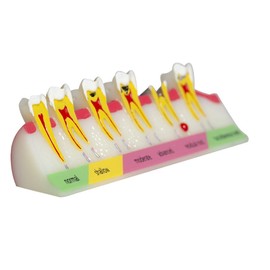 RuiJOTWAT Caries Development Model for Dental Anatomy Research, Oral Care Education