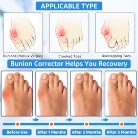Healrecux Bunion Corrector for Women Men, 2Pcs Bunion Toe Corrector, Adjustable Bunion Splint Brace Big Toe Straightener for Bunion, Hallux Valgus Correction Day/Night Support