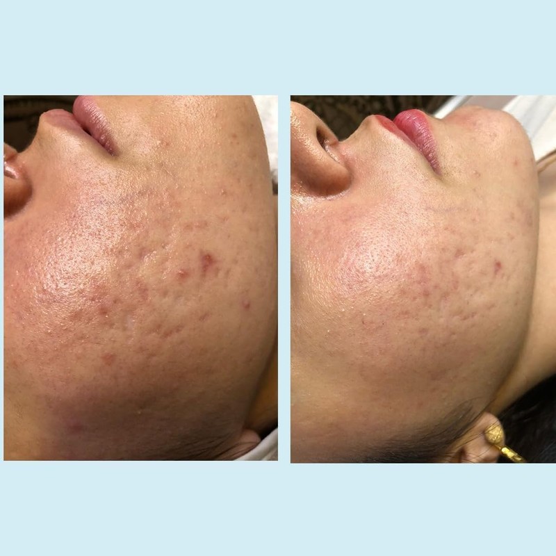 Salicylic Acid 20% Gel Peel - Enhanced with Tea Tree