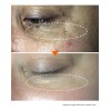 Eliminador De Oscuridad Para Hiperpigmentación Facial, Melas