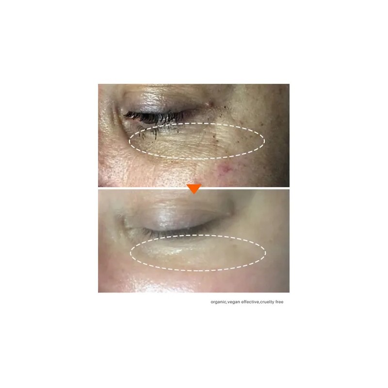 Eliminador De Oscuridad Para Hiperpigmentación Facial, Melas