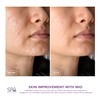 Spa Sciences MIO Diamond Microdermabrasion Blackhead Remover, Pore Suction Tool–Rechargeable-Dermatologist