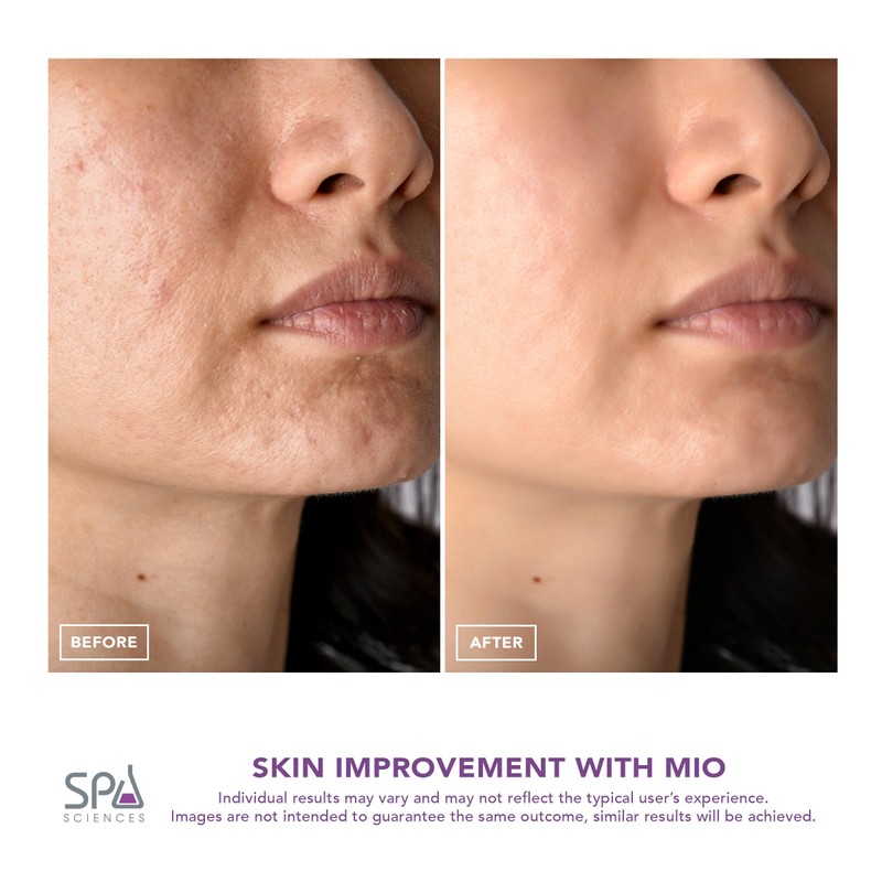 Spa Sciences MIO Diamond Microdermabrasion Blackhead Remover, Pore Suction Tool–Rechargeable-Dermatologist