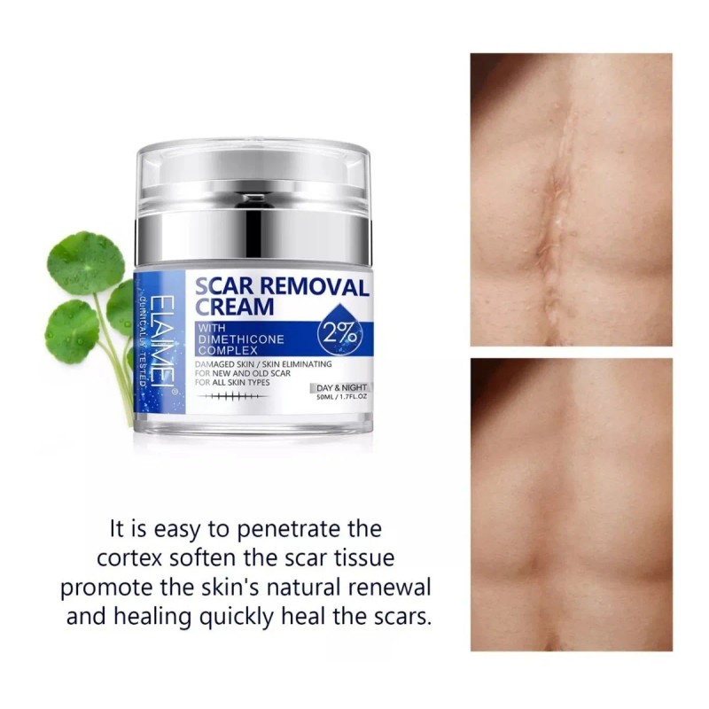 Crema/gel para cicatrices profundas, queloides, cacarizos