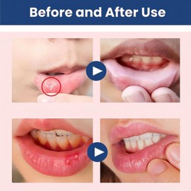 Cold Sore Cream,Cold Sore Treatment Cream,Mouth Ulcer Treatment for Adults,Gentle Sore Lips Treatment,Mouth Sore Treatment for Lips,Mouth Ulcer Gel,Fresh and Non-irritating,Natural Ingredients,20g