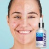 Serum Facial Pure Skin Retira Acné Y Espinillas 2pz Full