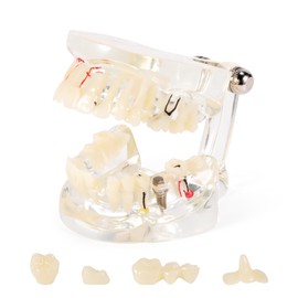 Annhua Transparent Disease Teeth Model for Dental Students, 32 Standard Typodont Teeth Model with Removable Crown Bridge, Pathological Teaching Models for Implant Education and Demonstration