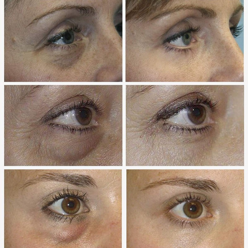 Lanbena 50 Parches para ojos Ácido Hialurónico + Vitamina C