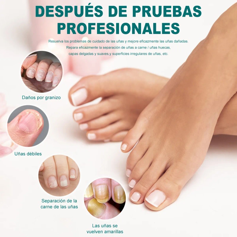 Ungüentopara Hongo De Uñas Elimina Eficazmente Los Hongo