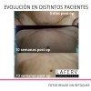 Crema Post Operación Cicatrizante Abdominoplastia Acné 2 Pza