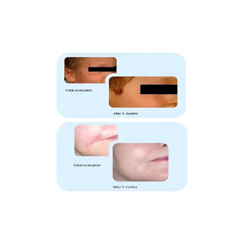 Crema Cicatrizante Dermatix Ultra Todo Tipo Piel 15g
