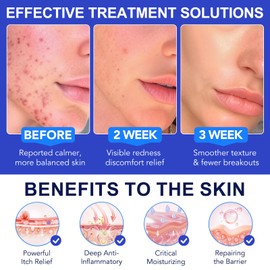 Acne Treatment for Face, Folliculitis Cream with 1% Salicylic Acid for Cystic – Multi-Purpose Gentle Herbal Formula for Scalp, Face & Body – Soothes Redness, Helps Prevent New Pimples, Fast Acting
