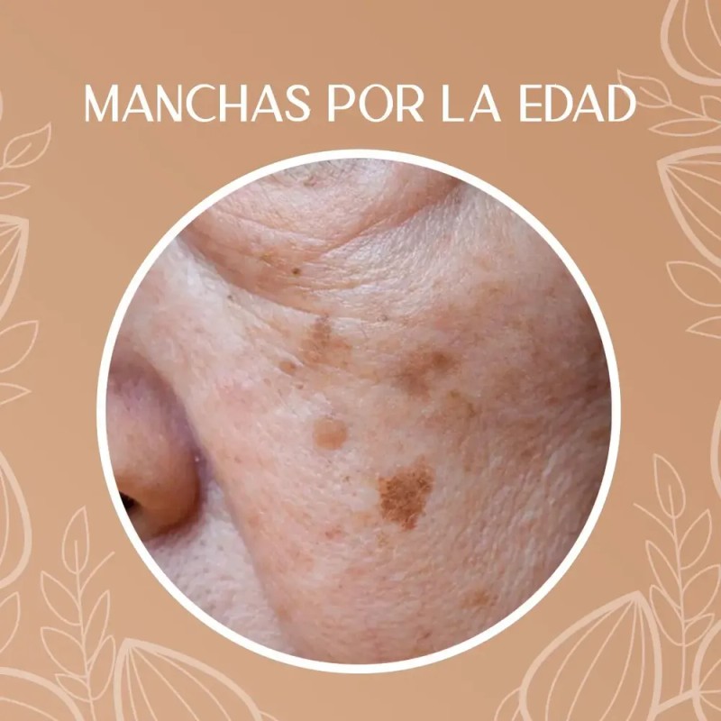 Crema Despigmentante Para Manchas, Melasma, Acné Y Paño
