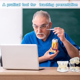 Willoghsa Disease Tooth Model, Dental Typodonte Implant Dental Model with Removable Teeth, Dentist Standard Dental Demonstration