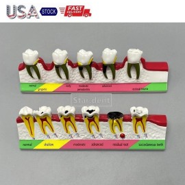 Unbranded Dental Teeth Dentoform Models Caries Disease Periodontal Endodontics Teach Model - Caries + Periodontal