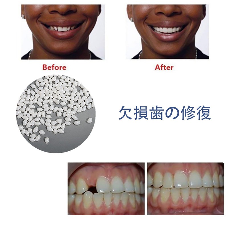ALLVD Dental Resin Denture Repair Kit, Temporary Denture Replacement Kit,
