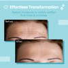 Forehead Wrinkle Patches Reusable | Non-Invasive Wrinkle Treatment for Fine