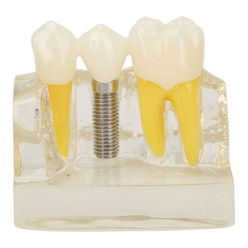 Teeth Implant Model Transparent Dental Teaching Research Demonstration Teeth Model