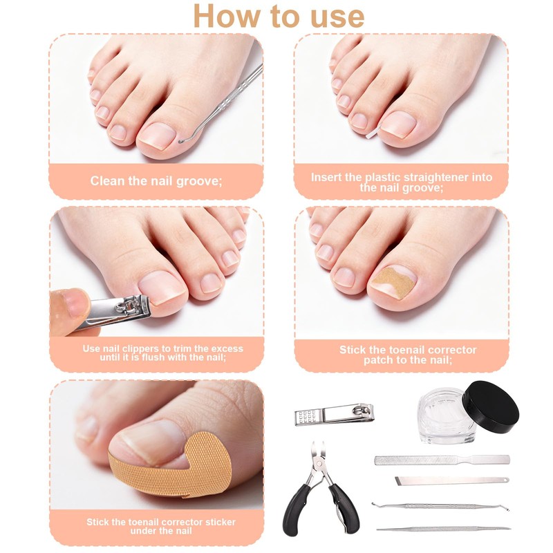 106pcs Ingrown Toenail Corrector Kit, Toenail Correction Strips Tape Ingrown