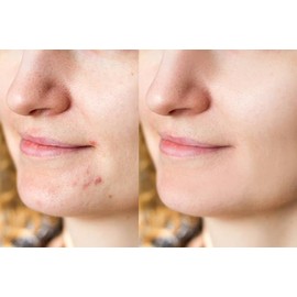 FAST ACTING SPOT PATCHES by Chéz Foxy. Hydrocolloid Acne Pimple Patch for Covering Spots, Blemishes and Skin break outs. Spot Stickers for Face and Skin (36 Count)