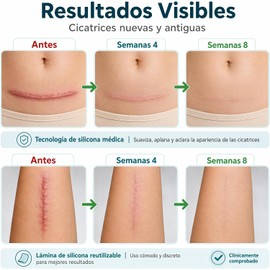 Parches Silicona para Cicatrices – Láminas Reutilizables para Cesárea y Acné