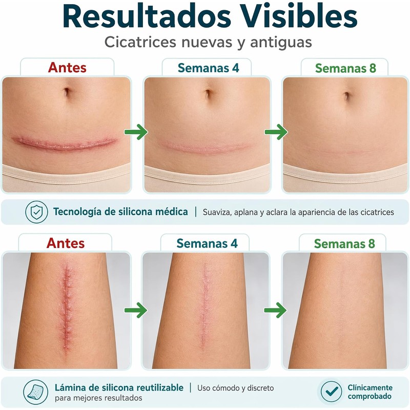 Parches Silicona para Cicatrices – Láminas Reutilizables para Cesárea y