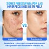 2pcs 20% Ácido Azelaico Crema Con Vitamina C Y Niacinamida