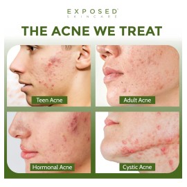 Tratamiento Acné Básico Exposed Skin Care, Con Todos Los Ing