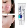 Tratamiento Acne Puntos Negros Manchas Cicatrices Barros 2pz
