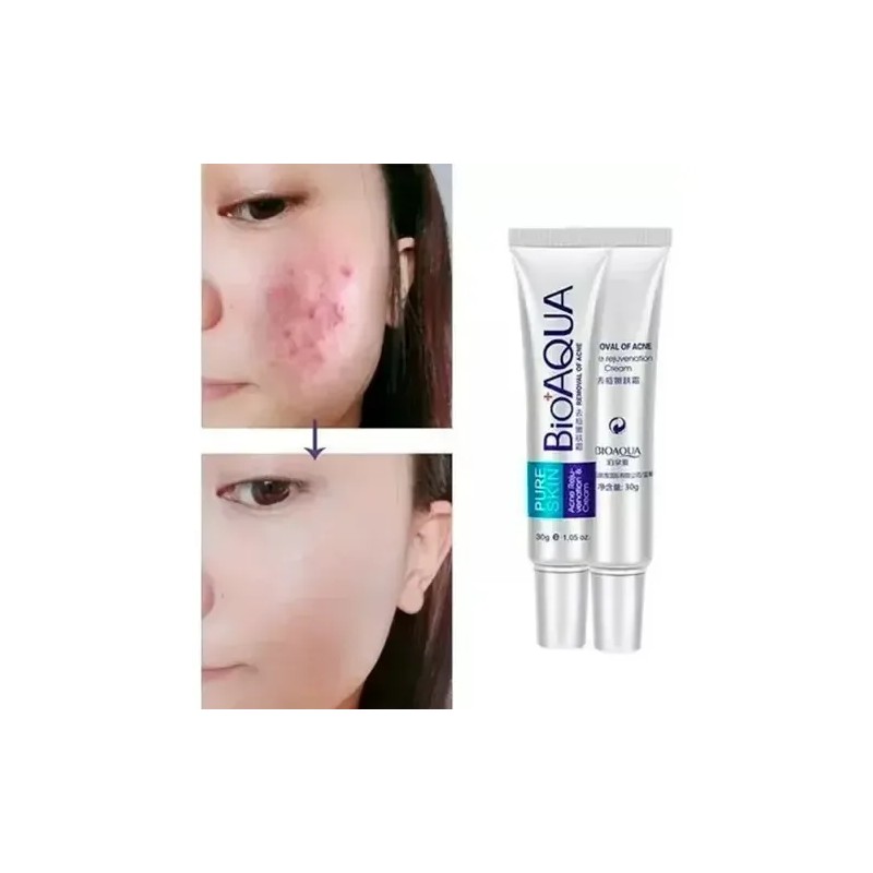 Tratamiento Acne Puntos Negros Manchas Cicatrices Barros 2pz