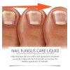 Líquido Para Hongos En Uñas - Cura Hongos Y Onicomicosis
